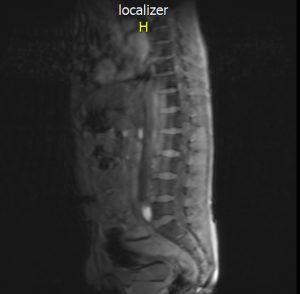 MRI-scan